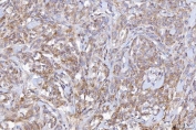 IHC staining of FFPE human lymphoma tissue with CD10 antibody. HIER: boil tissue sections in pH8 EDTA for 20 min and allow to cool before testing.