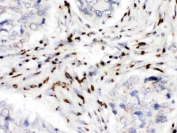 IHC staining of FFPE human lung cancer tissue with MDM4 antibody. HIER: boil tissue sections in pH8 EDTA for 20 min and allow to cool before testing.