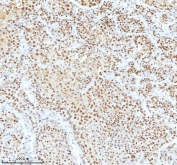 IHC staining of FFPE human liver cancer tissue with Ku70 antibody. HIER: boil tissue sections in pH8 EDTA for 20 min and allow to cool before testing.