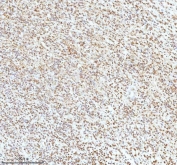 IHC staining of FFPE human glioblastoma tissue with Ku70 antibody. HIER: boil tissue sections in pH8 EDTA for 20 min and allow to cool before testing.