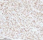 IHC staining of FFPE human bladder cancer tissue with Ku70 antibody. HIER: boil tissue sections in pH8 EDTA for 20 min and allow to cool before testing.