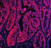 Immunofluorescent staining of FFPE human colon cancer tissue with Ku70 antibody (red) and DAPI nuclear stain (blue). HIER: steam section in pH8 EDTA buffer for 20 min.