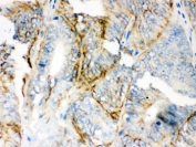 IHC testing of FFPE human intestinal cancer with PKLR antibody. HIER: Boil the paraffin sections in pH 6, 10mM citrate buffer for 20 minutes and allow to cool prior to staining.