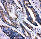 IHC testing of FFPE human intestinal cancer tissue with GRP75 antibody. HIER: Boil the paraffin sections in pH8 EDTA buffer for 20 minutes and allow to cool prior to staining.