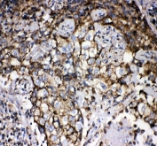 IHC testing of FFPE human lung cancer tissue with GRP75 antibody. HIER: Boil the paraffin sections in pH8 EDTA buffer for 20 minutes and allow to cool prior to staining.