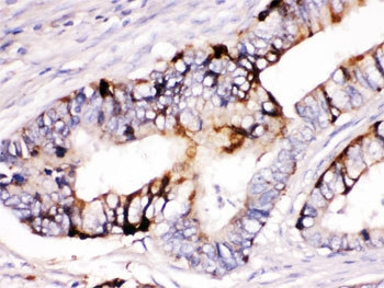 IHC testing of FFPE human intestine cancer tissue with ZP2 antibody. HIER: Boil the paraffin sections in pH 6, 10mM citrate buffer for 20 minutes and allow to cool prior to staining.