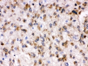 IHC testing of FFPE human glioma tissue with Otoferlin antibody. HIER: Boil the paraffin sections in pH 6, 10mM citrate buffer for 20 minutes and allow to cool prior to staining.