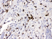 IHC testing of FFPE human intestinal cancer tissue with ORM1 antibody. HIER: Boil the paraffin sections in pH 6, 10mM citrate buffer for 20 minutes and allow to cool prior to testing.