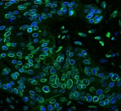 Immunofluorescent staining of FFPE human esophageal squamous cell carcinoma with Emerin antibody (green) at 1ug/ml and DAPI nuclear stain (blue). HIER: boil tissue sections in pH6, 10mM citrate buffer, for 10-20 min and allow to cool before testing.