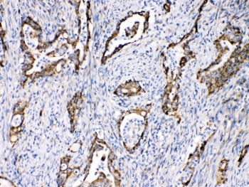 IHC testing of FFPE human intestinal cancer tissue with TECTA antibody at 1ug/ml. Required HIER: steam section in pH6 citrate buffer for 20 min and allow to cool prior to testing.