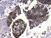 IHC testing of FFPE human lung cancer tissue with MMP16 antibody at 1ug/ml. Required HIER: steam section in pH6 citrate buffer for 20 min and allow to cool prior to testing.