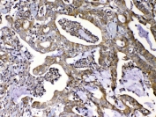 IHC testing of FFPE human colon cancer tissue with MMP16 antibody at 1ug/ml. Required HIER: steam section in pH6 citrate buffer for 20 min and allow to cool prior to testing.