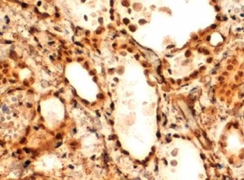IHC testing of FFPE human thyroid gland with FOXE1 antibody at 2ug/ml. HIER: steamed with pH9 Tris/EDTA buffer, HRP-staining.~