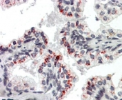 IHC testing of FFPE human prostate with Pleiotrophin antibody at 3.8ug/ml. Distinct staining at the base of the glands is seen. HIER: steamed with pH6 citrate buffer, AP-staining.