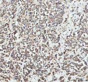 IHC staining of FFPE human breast cancer tissue with EEA1 antibody. HIER: boil tissue sections in pH8 EDTA for 20 min and allow to cool before testing.
