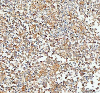 IHC testing of FFPE human testicular germ cell tumor tissue with CP110 antibody. Required HIER: steam section in pH8 EDTA buffer for 20 min and allow to cool prior to testing.