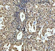 IHC staining of FFPE human lung cancer tissue with SP6 antibody. HIER: boil tissue sections in pH8 EDTA for 20 min and allow to cool before testing.