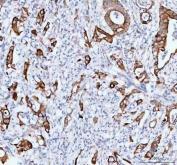 IHC staining of FFPE human colorectal adenocarcinoma tissue with TACI antibody. HIER: boil tissue sections in pH8 EDTA for 20 min and allow to cool before testing.