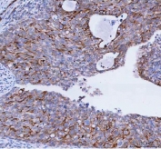 IHC staining of FFPE human cervical cancer tissue with TACI antibody. HIER: boil tissue sections in pH8 EDTA for 20 min and allow to cool before testing.