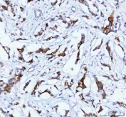 IHC staining of FFPE human breast cancer tissue with TACI antibody. HIER: boil tissue sections in pH8 EDTA for 20 min and allow to cool before testing.