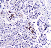 IHC staining of FFPE human pancreatic cancer with BTC antibody at 1ug/ml. HIER: boil tissue sections in pH6, 10mM citrate buffer, for 10-20 min followed by cooling at RT for 20 min.