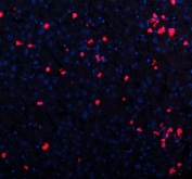 Immunofluorescent staining of FFPE human hepatitis tissue with CXCL12 antibody (red) and DAPI nuclear stain (blue). HIER: boil tissue sections in pH8 EDTA for 20 min and allow to cool before testing.