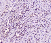 IHC staining of FFPE human rectal cancer with LATS1 antibody at 1ug/ml. HIER: boil tissue sections in pH6, 10mM citrate buffer, for 10-20 min followed by cooling at RT for 20 min.