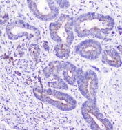 IHC staining of FFPE human cholangiocarcinoma with LATS1 antibody at 1ug/ml. HIER: boil tissue sections in pH6, 10mM citrate buffer, for 10-20 min followed by cooling at RT for 20 min.