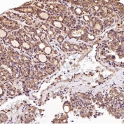 IHC staining of FFPE human thyroid cancer with EGFR antibody. HIER: boil tissue sections in pH6, 10mM citrate buffer, for 10-20 min and allow to cool before testing.