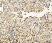 IHC staining of FFPE human liver cancer with Haptoglobin antibody at 1ug/ml. HIER: boil tissue sections in pH6, 10mM citrate buffer, for 10-20 min and allow to cool before testing.
