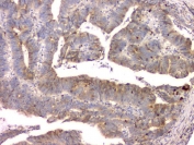 IHC staining of FFPE human colon cancer with Cystatin C antibody. HIER: boil tissue sections in pH8 EDTA for 20 min and allow to cool before testing.