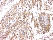 IHC staining of FFPE human glioma with Cystatin C antibody. HIER: boil tissue sections in pH8 EDTA for 20 min and allow to cool before testing.