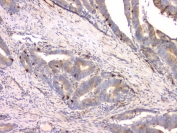 IHC staining of FFPE human colon cancer with Cystatin C antibody. HIER: boil tissue sections in pH8 EDTA for 20 min and allow to cool before testing.