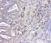IHC staining of FFPE human intestinal cancer with RRBP1 antibody at 1ug/ml. HIER: boil tissue sections in pH6, 10mM citrate buffer, for 10-20 min and allow to cool before testing.
