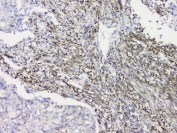 IHC staining of FFPE human lung cancer with RRBP1 antibody at 1ug/ml. HIER: boil tissue sections in pH6, 10mM citrate buffer, for 10-20 min and allow to cool before testing.