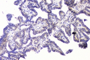 IHC staining of FFPE human thyroid cancer with RRBP1 antibody at 1ug/ml. HIER: boil tissue sections in pH6, 10mM citrate buffer, for 10-20 min and allow to cool before testing.
