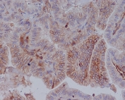 IHC staining of FFPE human thyroid cancer with HLA-A antibody. HIER: boil tissue sections in pH6, 10mM citrate buffer, for 10-20 min and allow to cool before testing.