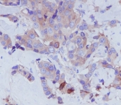 IHC staining of FFPE human breast carcinoma tissue with Transferrin antibody. HIER: boil tissue sections in pH8 EDTA for 20 min and allow to cool before testing.