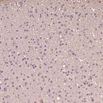 IHC staining of FFPE human glioblastoma tissue with S100 beta antibody. HIER: boil tissue sections in pH6, 10mM citrate buffer, for 10-20 min and allow to cool before testing.