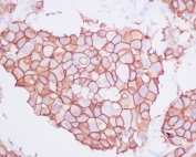IHC staining of FFPE human breast carcinoma with HER2 antibody. HIER: boil tissue sections in pH6, 10mM citrate buffer, for 10-20 min and allow to cool before testing.