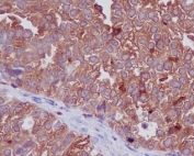 IHC staining of FFPE human ovarian cancer with CTSD antibody. HIER: boil tissue sections in pH6, 10mM citrate buffer, for 10-20 min and allow to cool before testing.
