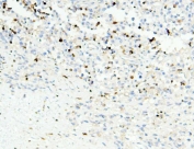 IHC staining of FFPE human testis cancer with APOBEC3G antibody. HIER: boil tissue sections in pH8 EDTA for 20 min and allow to cool before testing.