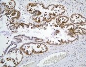 IHC staining of FFPE human ovarian cancer with BHC80 antibody. HIER: boil tissue sections in pH6, 10mM citrate buffer, for 20 min and allow to cool before testing.