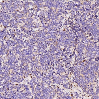 IHC staining of FFPE human small cell lung cancer tissue with LAMP-2A antibody. HIER: boil tissue sections in pH6, 10mM citrate buffer, for 10-20 min and allow to cool before testing.