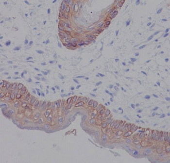 IHC staining of FFPE human skin tissue with Keratin 5 antibody. HIER: boil tissue sections in pH8 EDTA for 20 min and allow to cool before testing.