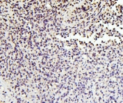 IHC staining of FFPE human testis cancer with SOX15 antibody. HIER: boil tissue sections in pH6, 10mM citrate buffer, for 20 min and allow to cool before testing.