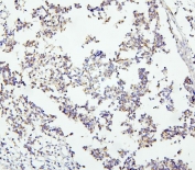 IHC staining of FFPE human glioma with DCC antibody. HIER: boil tissue sections in pH6, 10mM citrate buffer, for 20 min and allow to cool before testing.