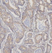 IHC staining of FFPE human intestinal cancer with TRPV3 antibody. HIER: boil tissue sections in pH6, 10mM citrate buffer, for 20 min and allow to cool before testing.