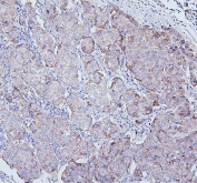 IHC staining of FFPE human breast cancer with TRPV3 antibody. HIER: boil tissue sections in pH6, 10mM citrate buffer, for 20 min and allow to cool before testing.
