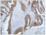IHC staining of FFPE human colon cancer with BubR1 antibody. HIER: boil tissue sections in pH8 EDTA buffer for 20 min and allow to cool before testing.